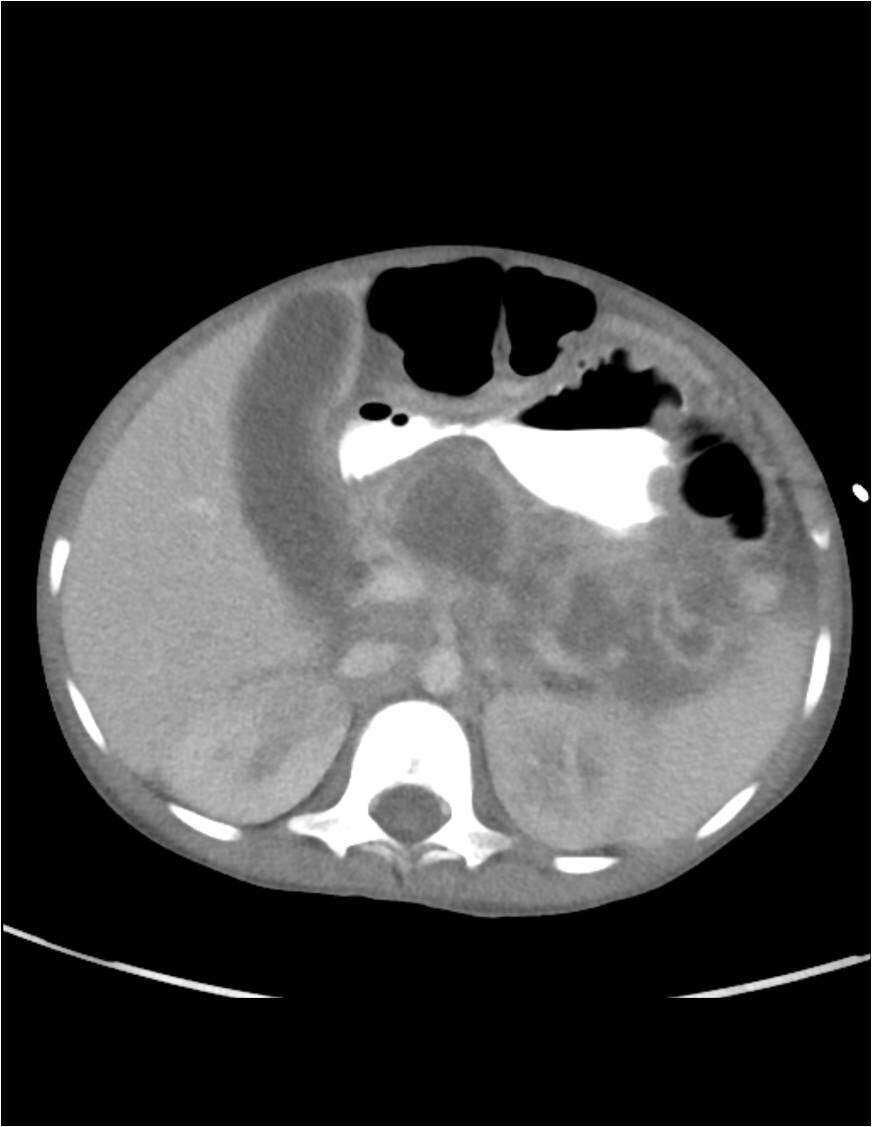 CT abdomen- enlarged pancreas